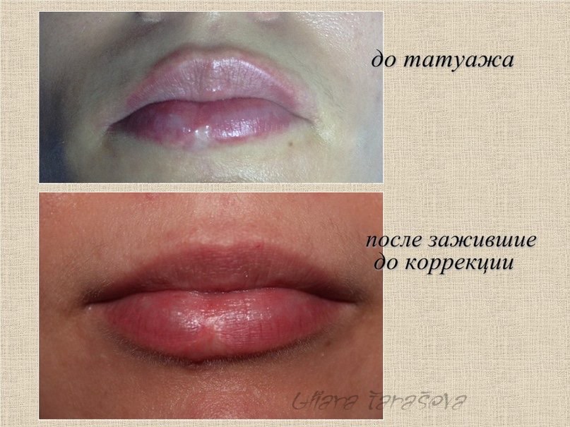 Заживление губ после перманентного макияжа по дням фото по дням