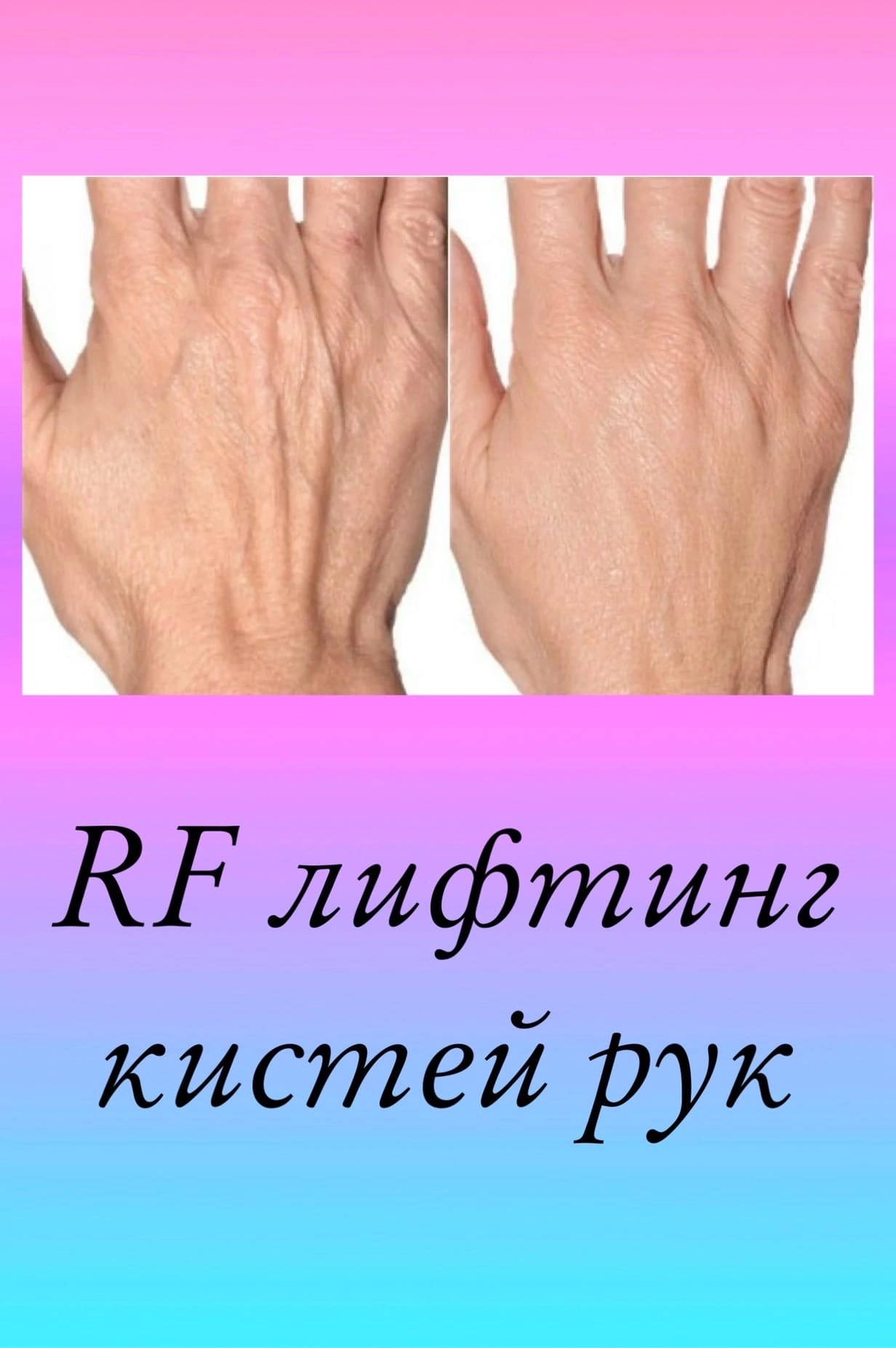 RF- !