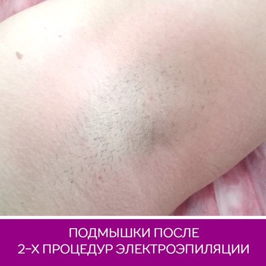 электроэпиляция курск