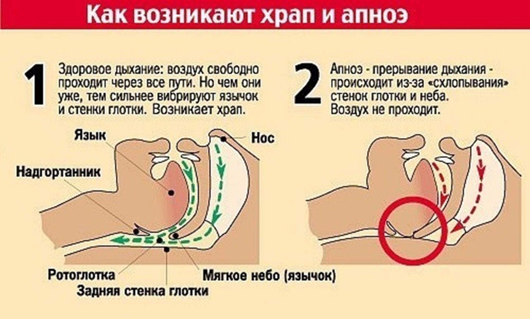 При выдохе слышен звук лопающихся пузырьков