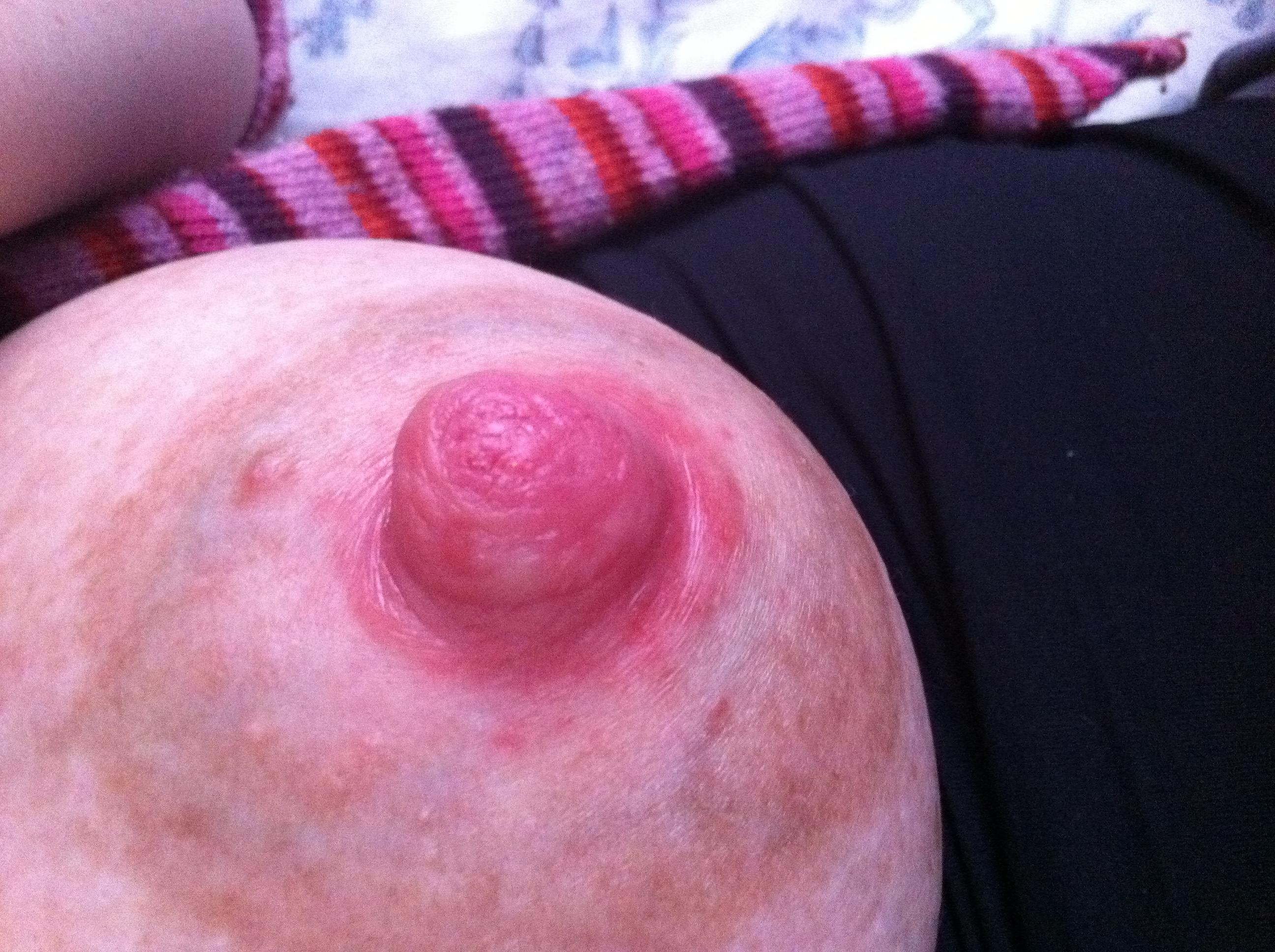 покраснение на груди у беременных фото 6