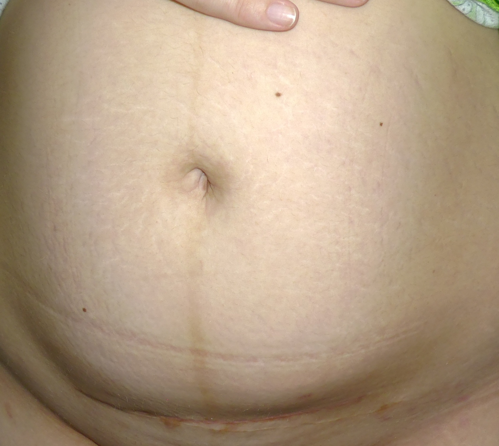 беременность сыпь на животе и груди фото 110