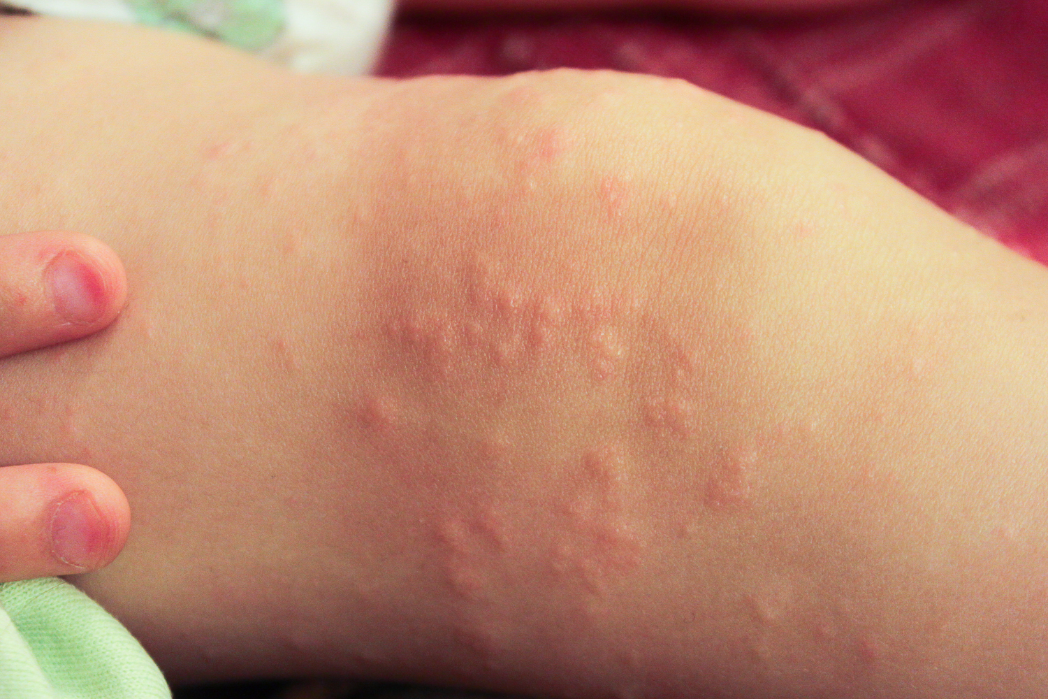 Атопический дерматит у ребенка 7 месячного((((