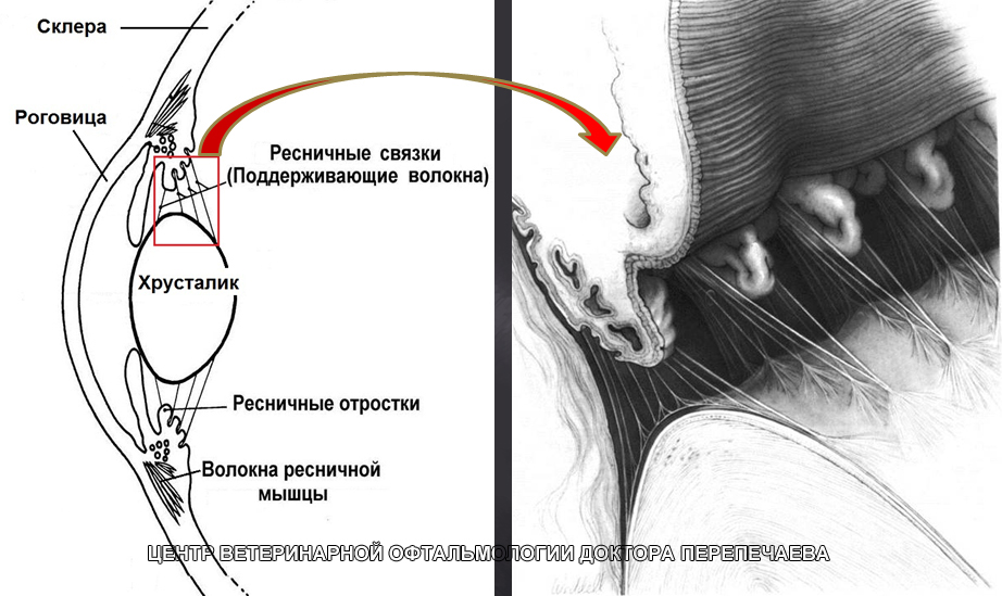 Вывих хрусталика. Связочный аппарат хрусталика (ресничный поясок). ресничная мышца и циннова связка. цилиарная связка. цилиарная мышца и хрусталик.