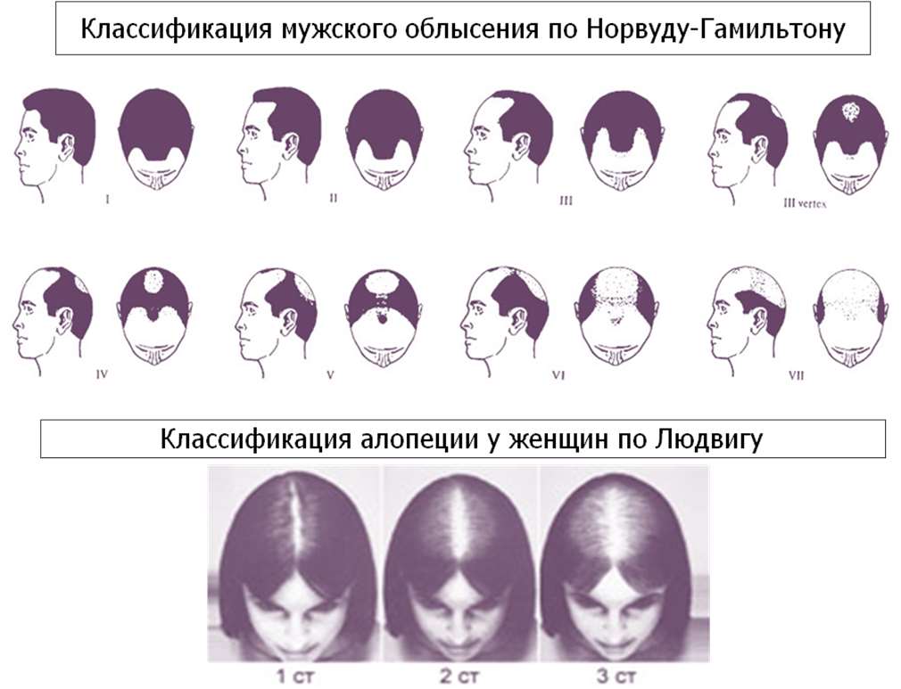 Выпадение волос классификация по