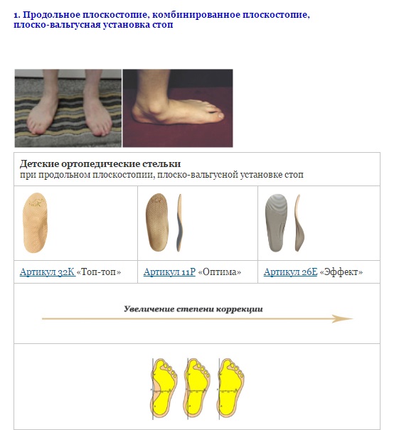 Плоско вальгусная стопа мкб